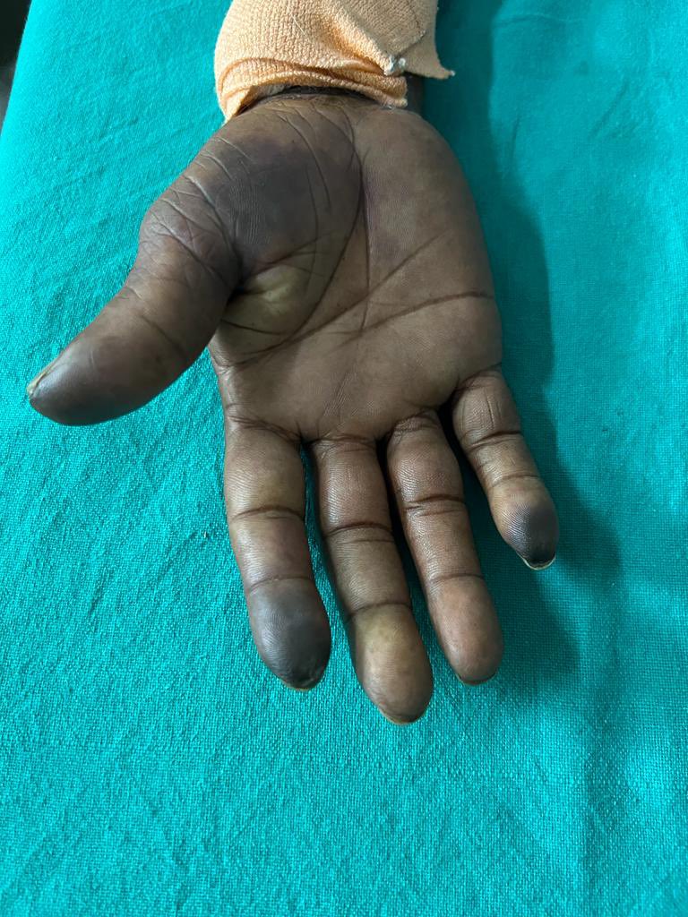 BHUSHAN MADKE MD on Twitter "Effect of smoking for many years