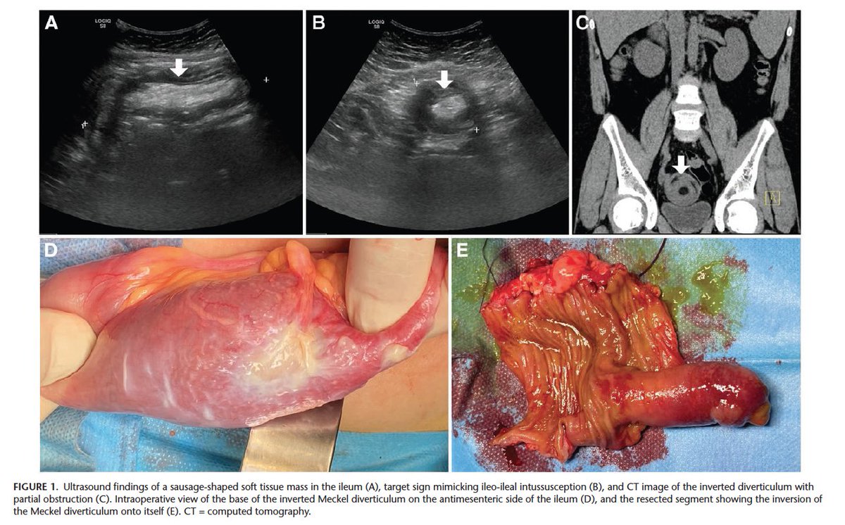 huseyinozbey13's tweet photo. Inverted Meckel’s diverticulum in a 13-year-old boy : Journal of Pediatric Gastroenterology and Nutrition
https://t.co/T8NFU0GtHw https://t.co/pH8EISoseS