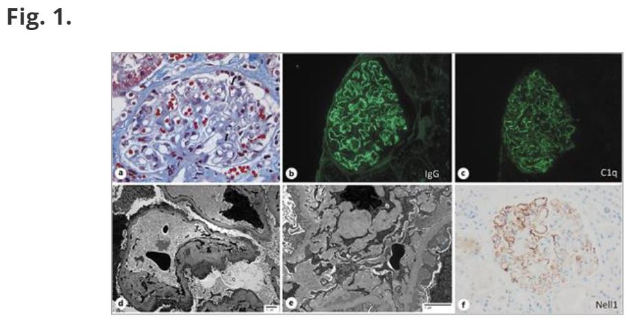 NephroKarger's tweet photo. #NELL1-Positive HIV-Associated Lupus-Like Membranous Nephropathy with Spontaneous Remission
🔗 https://t.co/VMmSfy8tXp
✍ Kumar P. et al.
📖 #GlomerularDis
#OpenAccess #HIV #Lupus https://t.co/Hkz0PdYeu1