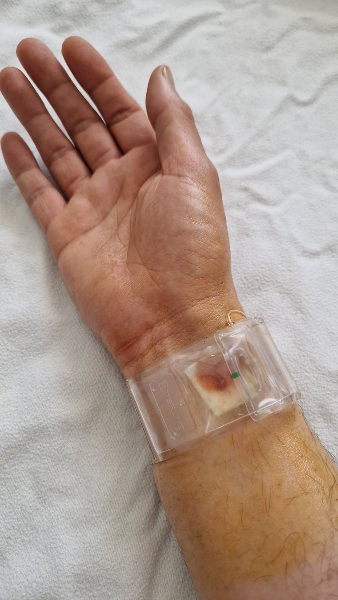 EiWasDann's tweet image. 40 hours, one ischemia, two cardioversions, a few docs and a bunch of head-shaking nurses later, since we are the worst period patients period ever period..

#nothinglikehome
 #helloagain
