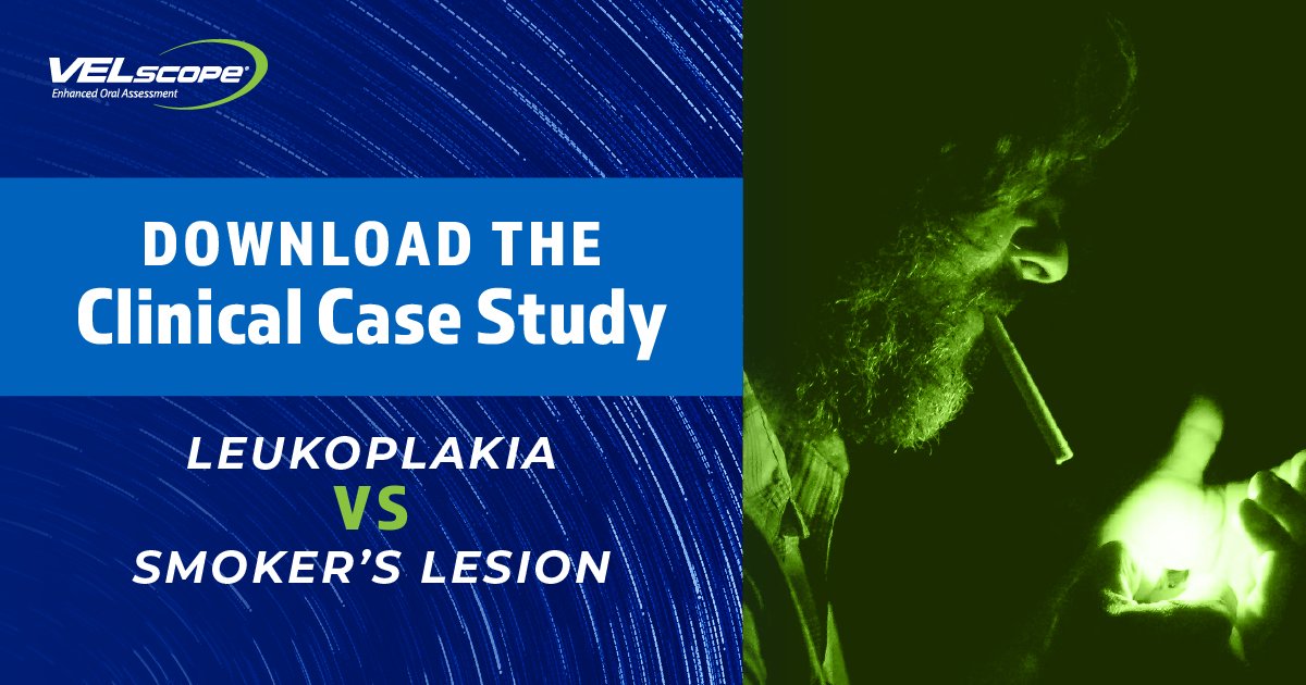 VELscope's tweet photo. DOWNLOAD CASE STUDY ➡️ https://t.co/976O6mGafz

🚬 LEUKOPLAKIA VS SMOKER’S LESION 

This case study, published in a peer-reviewed Czech journal, describes a patient who presented with a presumed smoker’s lesion which, 8 weeks after #smoking cessation,... https://t.co/HaIAN6ayhS https://t.co/FSvQWwdU55