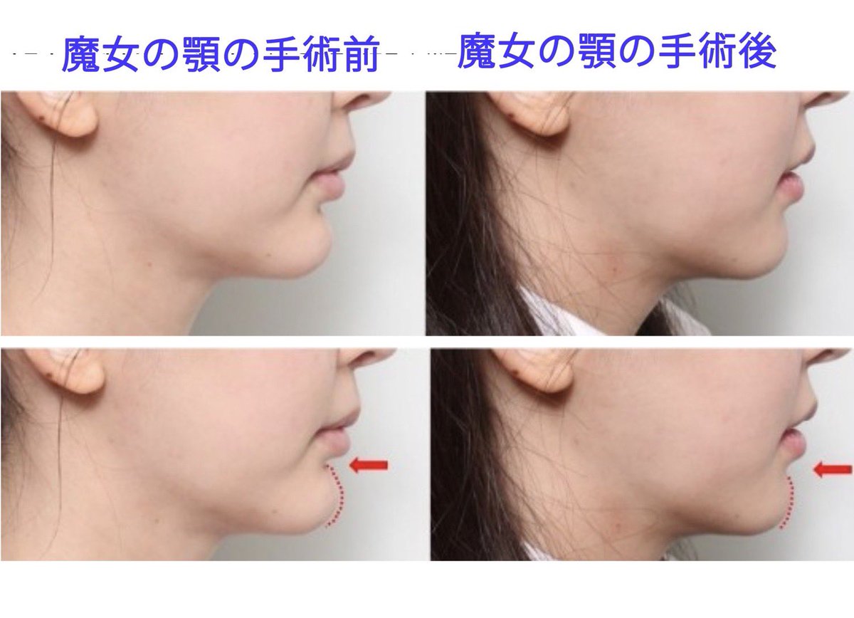 suni__fit's tweet photo. DA美容外科からノートに新しく来たムン·ヒョンソク院長が発表した魔女顎矯正の新しい手術法と症例がすごい。
ノートには
輪郭：ユジハン先生
胸：クォンスングン先生
目/鼻/リフト：ムンヒョンソク先生
このメンバーはアベンジャーズじゃん😳
ムン院長ブログ📝https://t.co/jyZGSJ7gby https://t.co/clOGJIKCUI