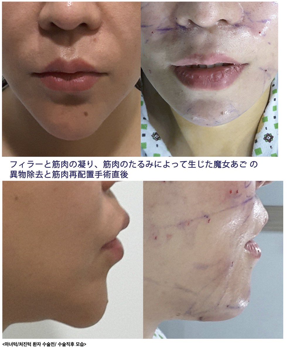 suni__fit's tweet photo. DA美容外科からノートに新しく来たムン·ヒョンソク院長が発表した魔女顎矯正の新しい手術法と症例がすごい。
ノートには
輪郭：ユジハン先生
胸：クォンスングン先生
目/鼻/リフト：ムンヒョンソク先生
このメンバーはアベンジャーズじゃん😳
ムン院長ブログ📝https://t.co/jyZGSJ7gby https://t.co/clOGJIKCUI