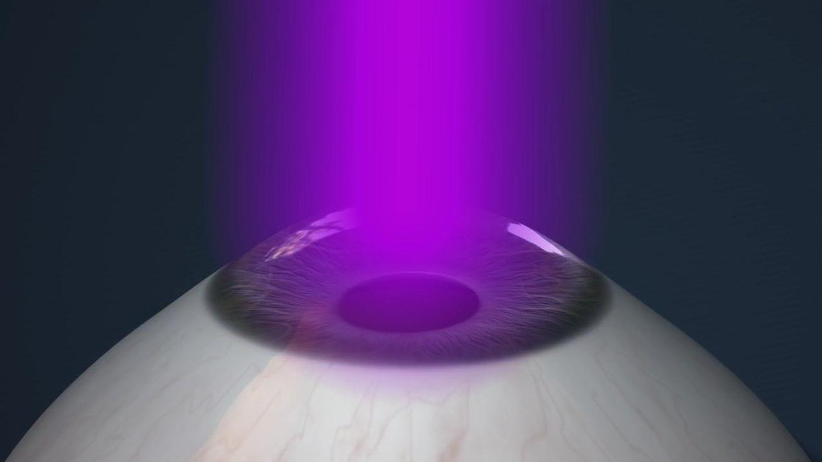 eyetechoptom's tweet photo. https://t.co/BwHN4e4Yz3 https://t.co/ZJ9u3j4NUT IKA Keratoconus Symposium 2023: Strategies for early diagnosis - Ophthalmology Times https://t.co/nBFBcs3748