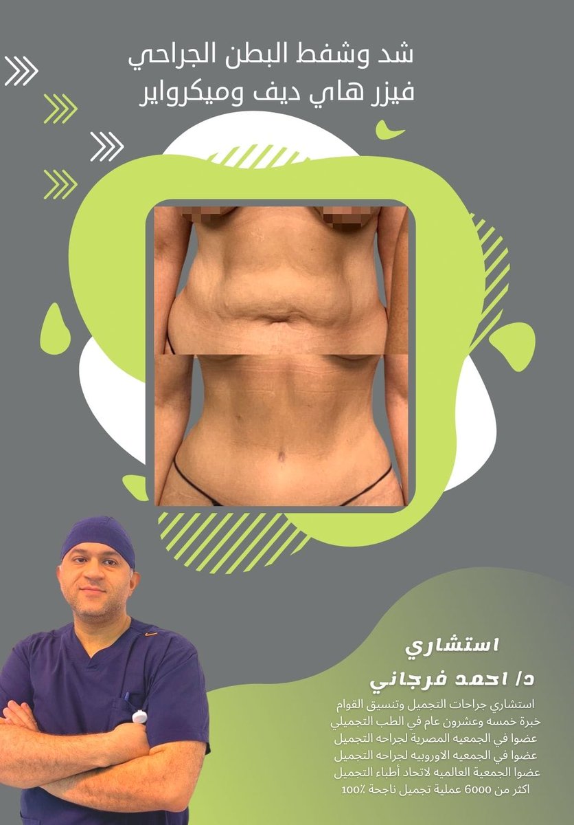 ebtsamatac2's tweet photo. شد البطن الجراحي بعد نزول الوزن أو #التكميم أو عمليات الامومة تتم مع استشاريين جراحات #التجميل وتنسيق القوام ذو الخبرة والكفاءة المميزة
يمكنك الحصول على الكشف والاستشاره لتقيم وتحديد أفضل الطرق المناسبه لك
توصل معنا للمزيد 📩
#رسالة_اليوم https://t.co/BI8julADaA