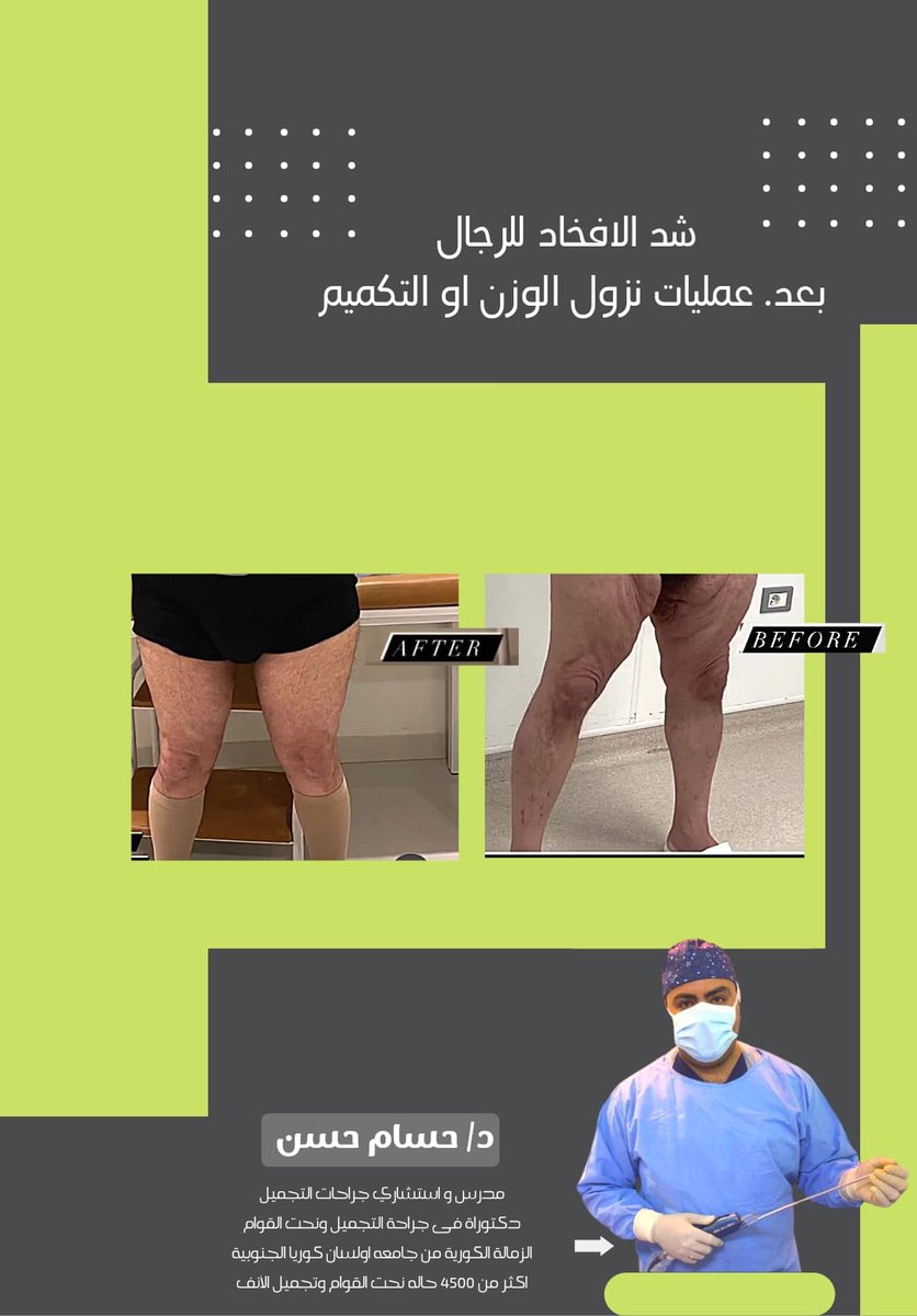 ebtsamatac2's tweet photo. شد البطن الجراحي بعد نزول الوزن أو #التكميم أو عمليات الامومة تتم مع استشاريين جراحات #التجميل وتنسيق القوام ذو الخبرة والكفاءة المميزة
يمكنك الحصول على الكشف والاستشاره لتقيم وتحديد أفضل الطرق المناسبه لك
توصل معنا للمزيد 📩
#رسالة_اليوم https://t.co/BI8julADaA