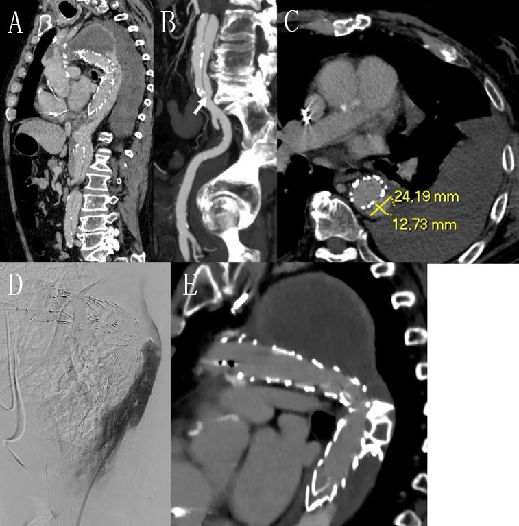 Vessel_Plus's tweet photo. Here is a #TechnicalNote about #FalseLumenThrombosis.
Expect more experts to comment on the article.
Please click on the link to read the full text: https://t.co/nopw3v3ENS https://t.co/q5AmYF47hP