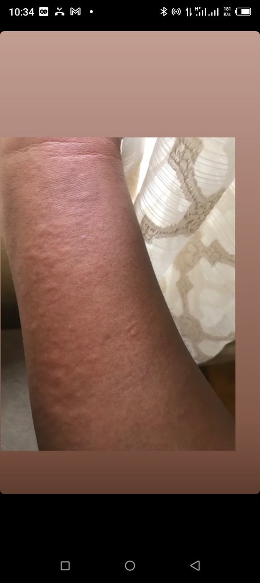 Bluntsuzzy's tweet photo. @lollypeezle So I am allergic to almost everything !! I am a living allergy princess . I also don't absorb glucose, galactose and maltose well, I have IBS and sinusitis.. but Nigerians think I'm forming when everyday is a battle for me , I have to watch what I eat , otherwise mans can just 💀 https://t.co/dbHpMwne4H