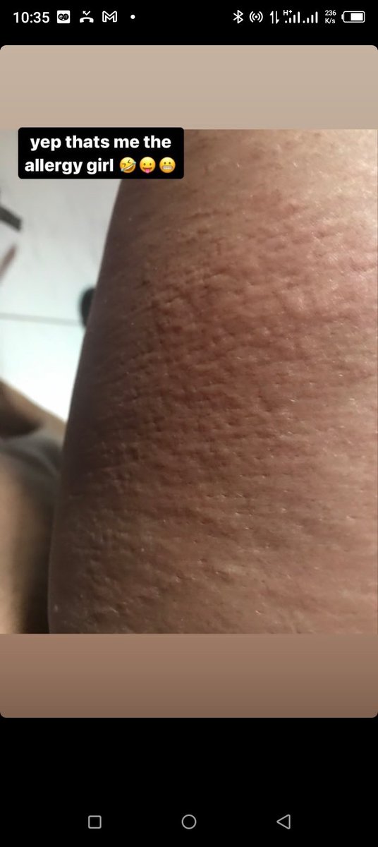 Bluntsuzzy's tweet photo. @lollypeezle So I am allergic to almost everything !! I am a living allergy princess . I also don't absorb glucose, galactose and maltose well, I have IBS and sinusitis.. but Nigerians think I'm forming when everyday is a battle for me , I have to watch what I eat , otherwise mans can just 💀 https://t.co/dbHpMwne4H