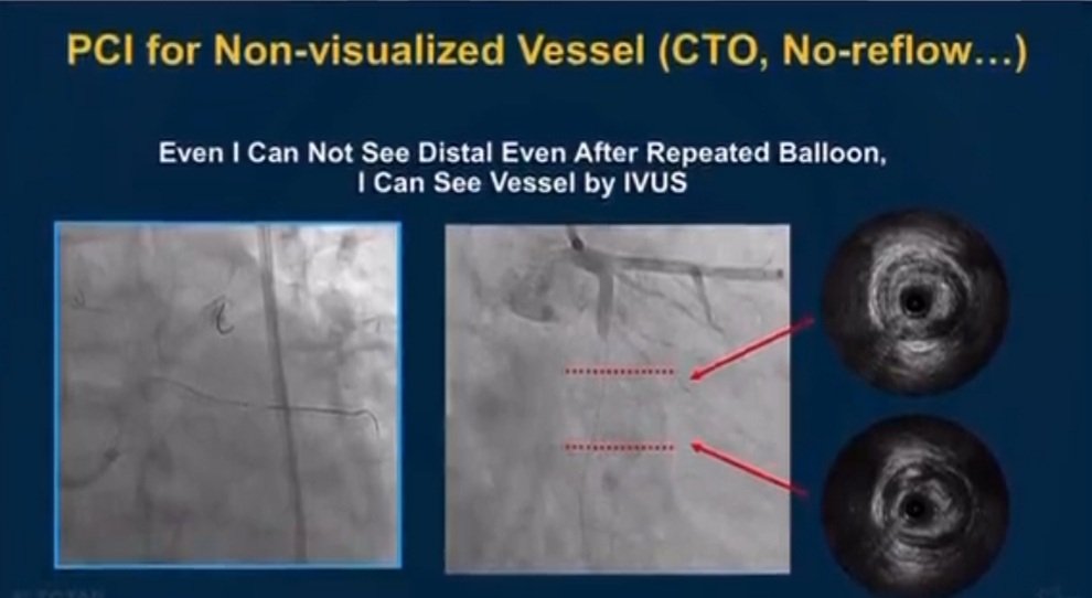 Zill_cardio's tweet image. #TCTAP2023 
@summitmd_cvrf

💥OCT 🆚️ IVUS: When, How, Why ⁉️

👉 When Is #IVUS Better ⤵️

#ImageFirst #IVUSvsOCT #CardioTwitter