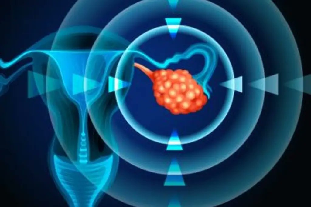 orpnoticiastux's tweet image. #Tecnociencia|🔬 ¿Qué es el cáncer de ovario y cómo detectarlo?
El cáncer de ovario no cuenta con una prueba como el papanicolao o mastografía para las mujeres, además de que es difícil de detectarlo porque muchas veces se confunde con colitis y gastritis, comentó Paulino Alfaro.
