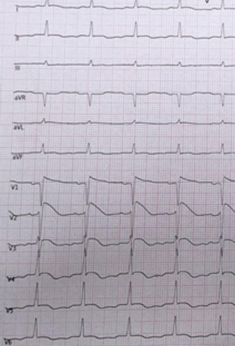 escardio's tweet image. #ESCardioEd challenge
 
❤️‍🩹 35 yo 🧑‍🦳mild hypertension
❤️‍🩹 #COVID19 infection - at home loss of consciousness after 3 days
❤️‍🩹 GCS 7, #IOT after admission, started propofol i.v.
❤️‍🩹 ECG: Ant. ST ⬆️, QTc 660 ms
❤️‍🩹 Cardiac markers ⬇️

What&apos;s your dx?