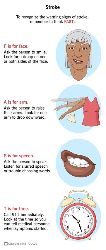 Problem is lot of Nigerians don't recognize when this happens like in this man 

Every minute wasted, Brain dies.  If people can recognize a stroke and get the patient to a hospital.  survival increases

Symptoms-
Face deviating to one side
 Weakness of hands &amp; legs