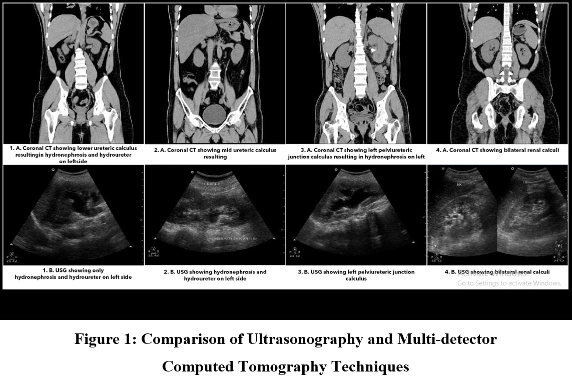 Role of Unenhanced Multi-Detector Computed Tomography in Detection of Urinary Calculi in Comparison with Ultrasonography
bit.ly/36ya11o
#Flankpain #UrinaryCalculi #UreteralCalculi #Tomography #Ultrasonography #biomedical #pharmacology #medicines #pharmaceuticals