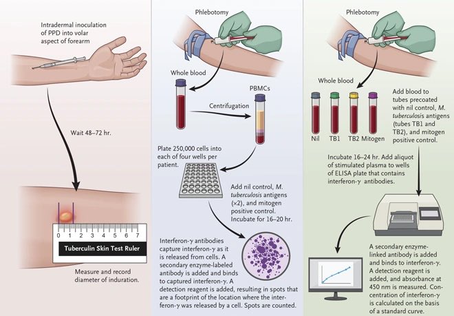 @Iamgoingtosleep @DrTedros @UN_PGA @endTB @StopTB @WHO @doctorsoumya @DrMariaNeira @Chikwe_I @WHO_Europe_TB @EndTB2025 @EndTB4SDGs @ECDC_TB Ordinary people know a lot more about ways to detect TB when it is inactive(latent). The WHO has done nothing to prevent the spread of TB in poor regions of the earth