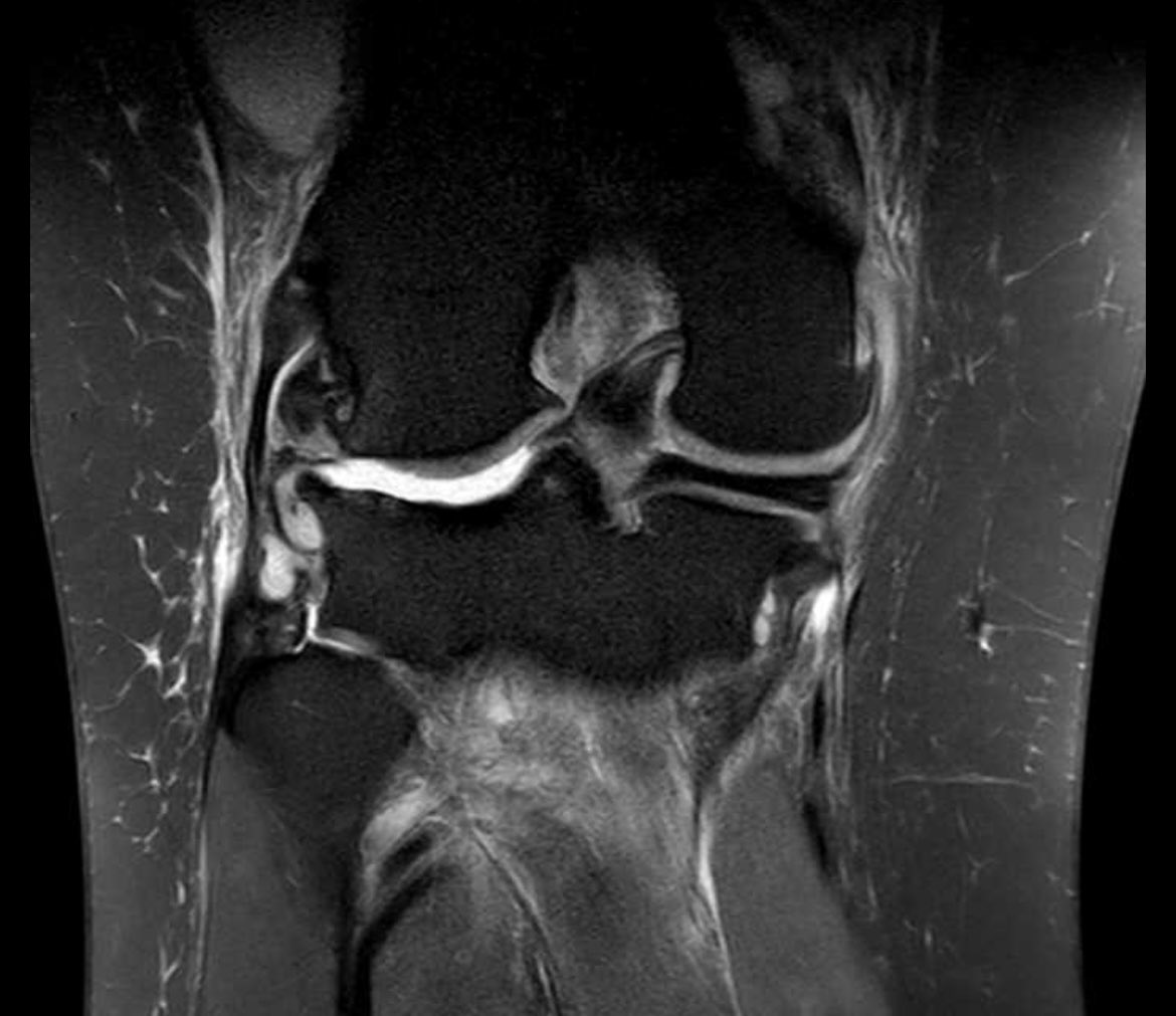 physizo's tweet image. 38 yo female. Persistent joint effusion and lack of extension.
I’m all for non surgical management - but this person has a loose body.
Post Sx = greater QofL, Function and has retired from elite level Sport.