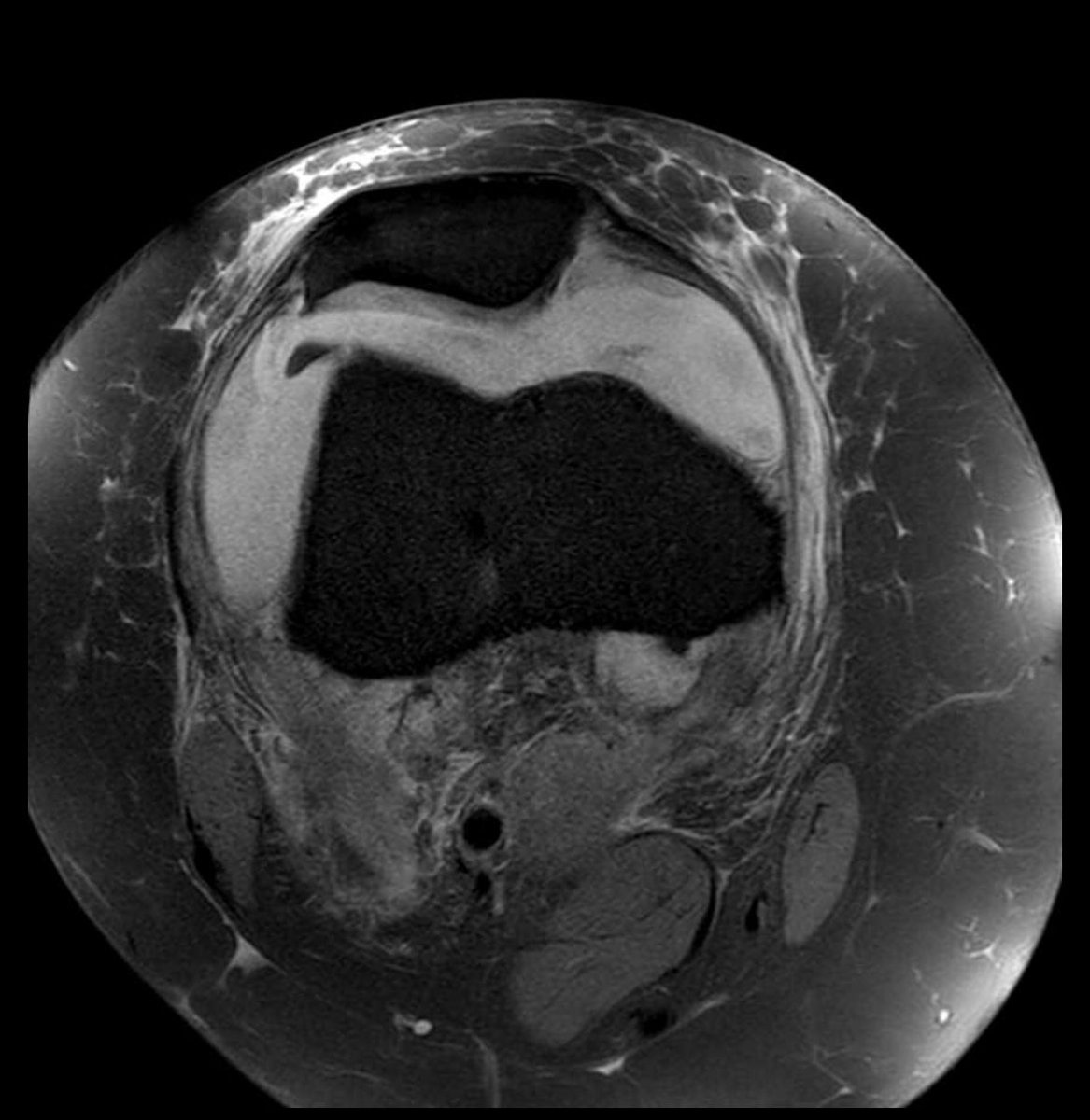 physizo's tweet image. 38 yo female. Persistent joint effusion and lack of extension.
I’m all for non surgical management - but this person has a loose body.
Post Sx = greater QofL, Function and has retired from elite level Sport.