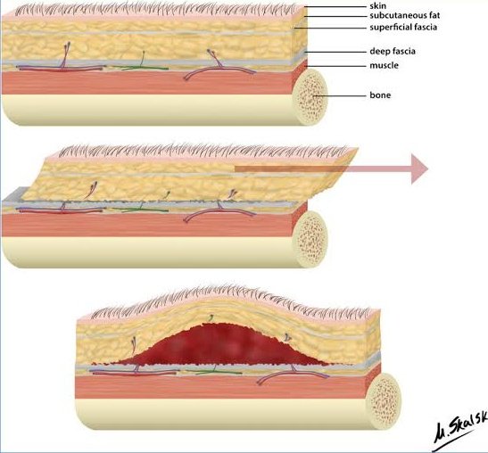 Alberto on Twitter "Síndrome de MorelLavallée separación traumática