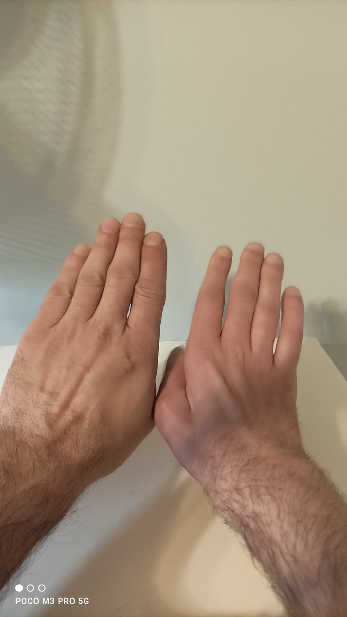 marcin_kuz8's tweet photo. Hello my name is Marcin. I have a problem with my health because i have Klumpke paralysis and Erb's palsy

I don't qualify to work because of that....
Could anybody could help??? I need help not money
to return to work in some way....😞 https://t.co/6sbCdZHUFu