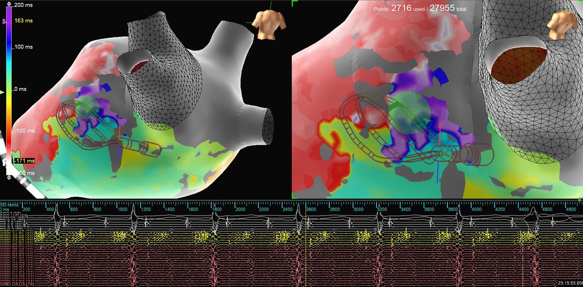 PVC_on_HERS's tweet photo. Terminations that make our hearts flutter ❤️

Redo AF pt. presented to the lab. PV and PW isolation was confirmed with #HDGrid. 

During EPS, 350ms AAFL was induced…
#EmphasisMaps highlighted our peak frequency fractionated 🎯!

#WelcomeToTheTParty @senthil_dorai @AbbottCardio https://t.co/uRpF6d4wj3