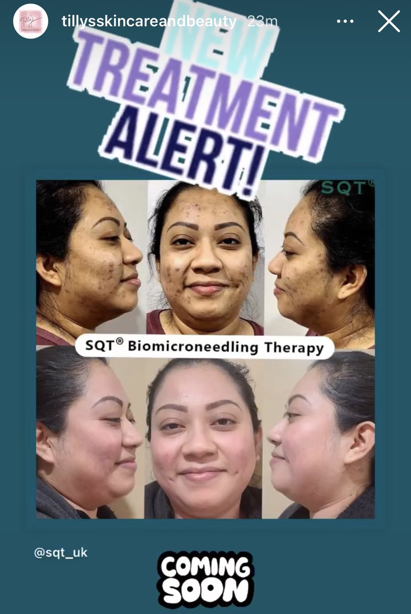 🤩 AMAZING RESULTS WITH THIS BEW TREATMENT 🤩

Sign up to our newsletter for availability to be the first to book 😍

Tillysskincareandbeauty.co.uk

#Plymouth #Skincare