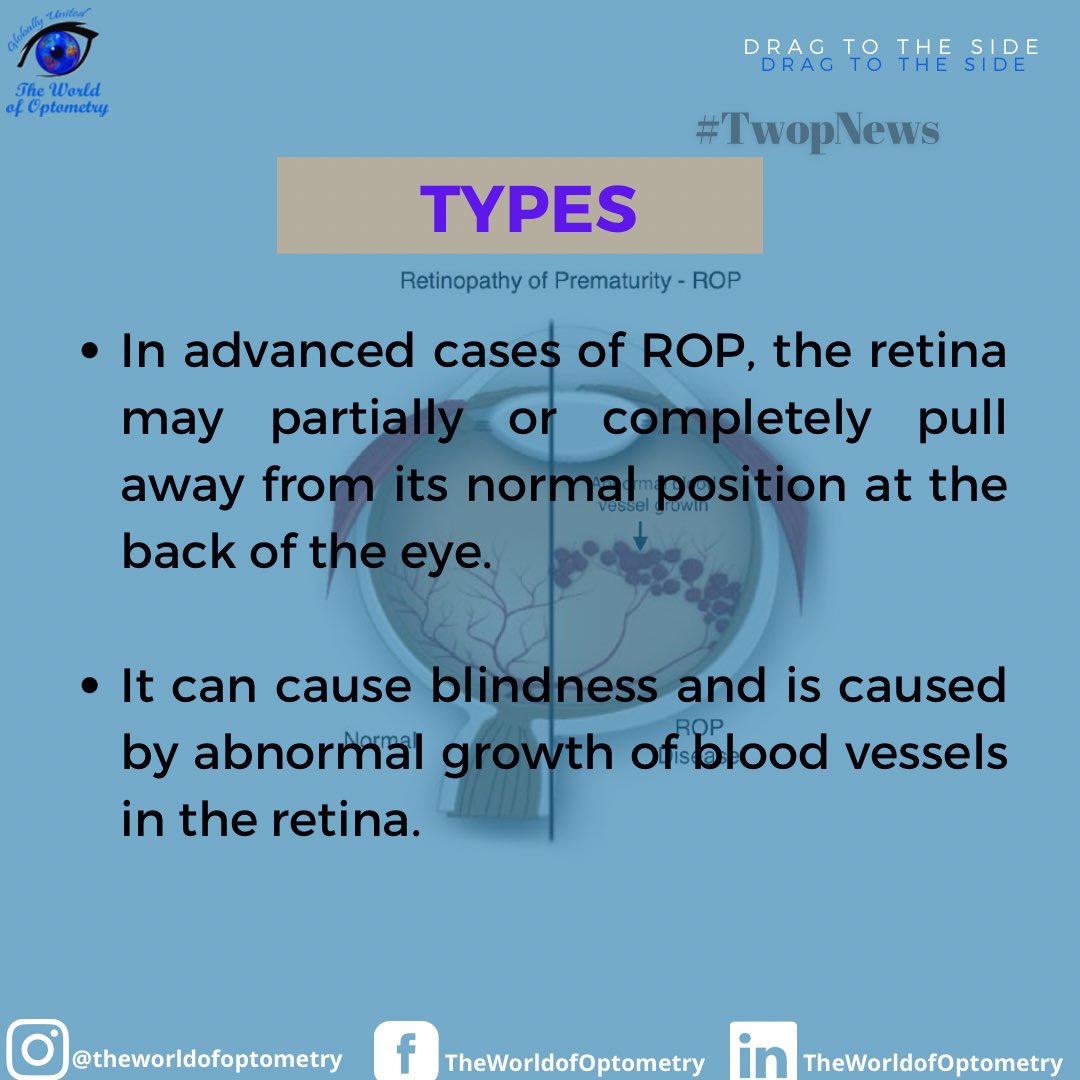 TWOPOFFICIAL's tweet photo. RETINOPATHY OF PREMATURITY (ROP)!

TWOP News brought to you by The World of Optometry, Globally United 🌎.

#TWOP #TheWorldofOptometry #Optometry #Optometrists #EyeCarePractitioners #OptometryStudents #EyeDoctors #EyeCare #VisualHealth #HealthyLife #Protectyoureyes #TwopMemes https://t.co/FtWAxBB5F1