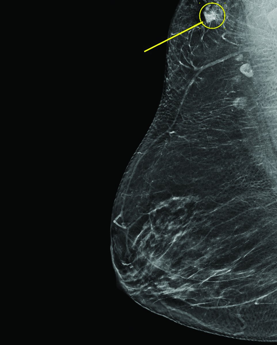 Applied_RadOnc's tweet photo. Radiation Therapy in Cancer of Accessory Breast Tissue: Questions for Treatment Guidelines, Case Series, and Literature Review ⏩https://t.co/BsJ4WfrBe8
#medicalstudent #futureradoncres #radoncres #radonc #medicalphysics #dosimetrist #radtherapist #oncology #radiationtherapy https://t.co/Z5pZcAoLQX
