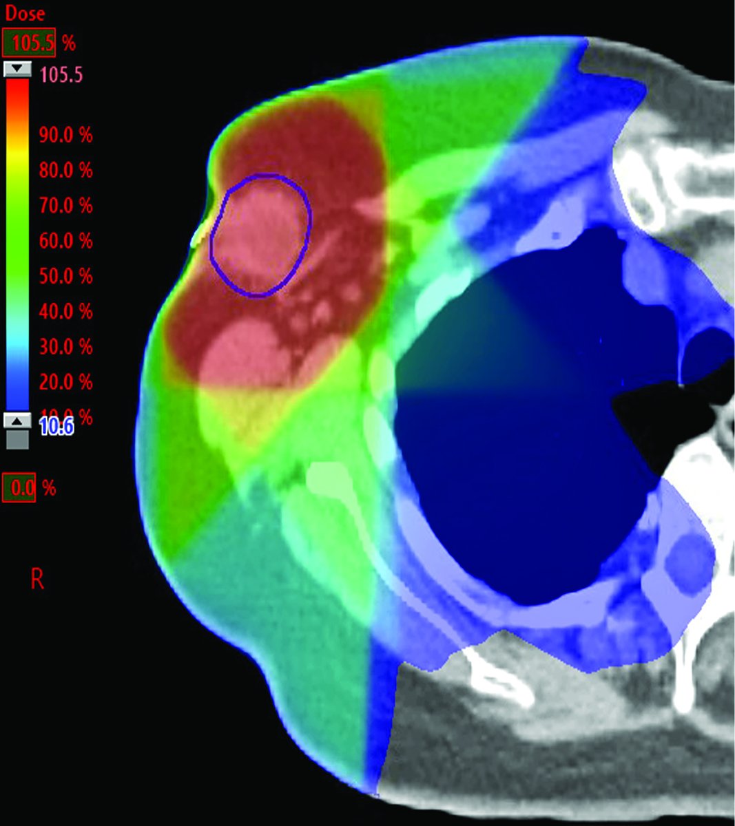 Applied_RadOnc's tweet photo. Radiation Therapy in Cancer of Accessory Breast Tissue: Questions for Treatment Guidelines, Case Series, and Literature Review ⏩https://t.co/BsJ4WfrBe8
#medicalstudent #futureradoncres #radoncres #radonc #medicalphysics #dosimetrist #radtherapist #oncology #radiationtherapy https://t.co/Z5pZcAoLQX