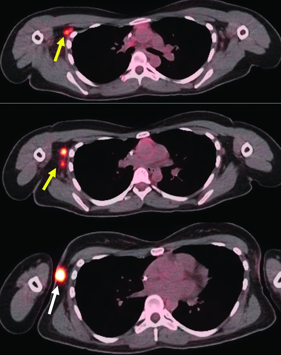 Applied_RadOnc's tweet photo. Radiation Therapy in Cancer of Accessory Breast Tissue: Questions for Treatment Guidelines, Case Series, and Literature Review ⏩https://t.co/BsJ4WfrBe8
#medicalstudent #futureradoncres #radoncres #radonc #medicalphysics #dosimetrist #radtherapist #oncology #radiationtherapy https://t.co/Z5pZcAoLQX