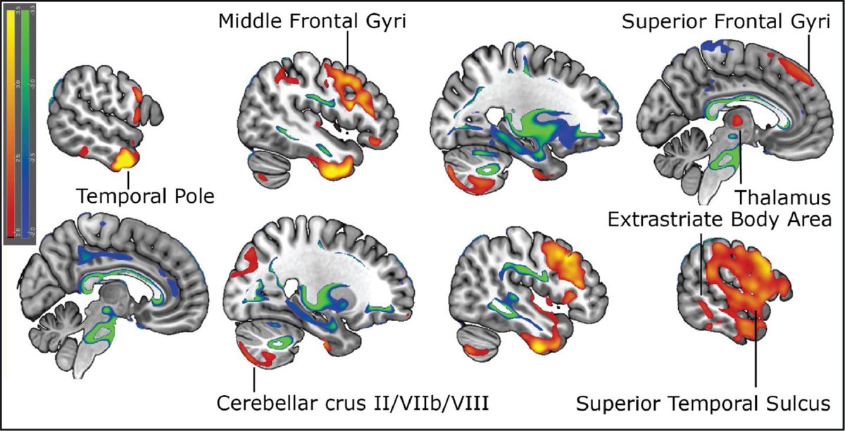 NYPAdvances (@nypadvances) on Twitter photo New research from <a href="/susmit_tripathi/">Susmit Tripathi, MD</a>, chief resident at <a href="/nyphospital/">NewYork-Presbyterian</a> <a href="/WCMCNeurology/">Weill Cornell Neurology</a>, studied patterns in gray matter volume to identify previously unrecognized areas of the brain that impact gait in #OlderAdults: nyphosp.co/44FISVQ #NYPAdvances #OlderAmericansMonth New research from <a href="/susmit_tripathi/">Susmit Tripathi, MD</a>, chief resident at <a href="/nyphospital/">NewYork-Presbyterian</a> <a href="/WCMCNeurology/">Weill Cornell Neurology</a>, studied patterns in gray matter volume to identify previously unrecognized areas of the brain that impact gait in #OlderAdults: nyphosp.co/44FISVQ #NYPAdvances #OlderAmericansMonth