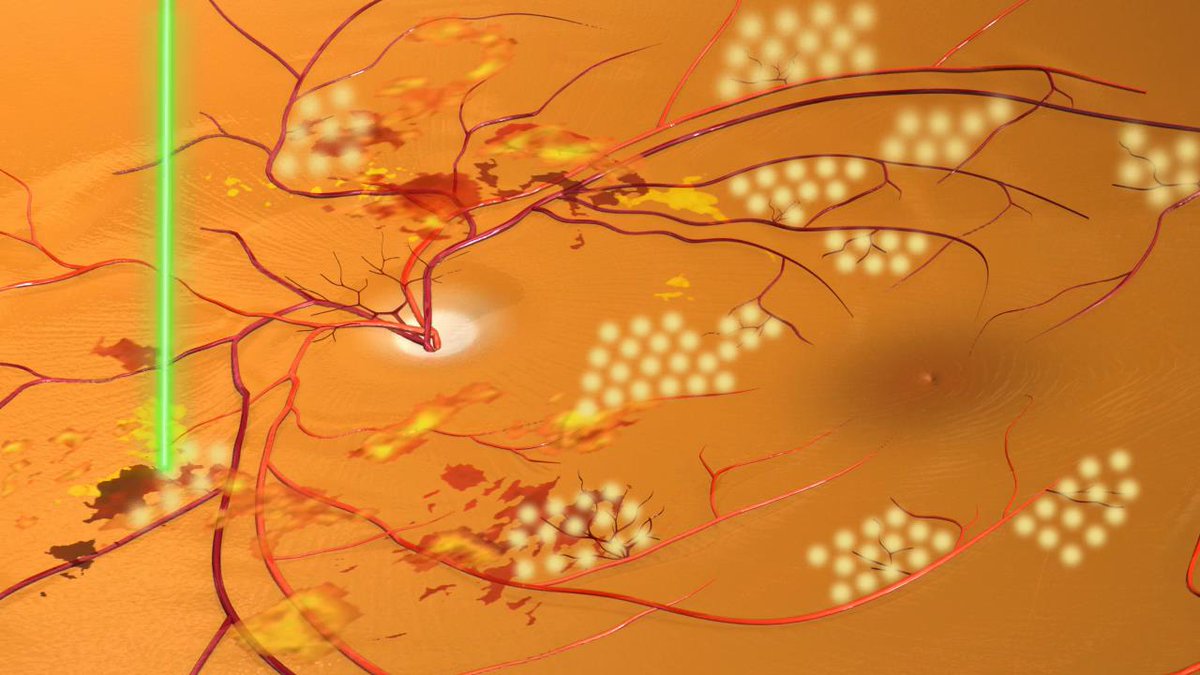 ow.ly/k2ns104G22O ow.ly/9YJM104GmiP Best Practices for Managing Diabetic Retinopathy in Patients with ... - Diabetes In Control