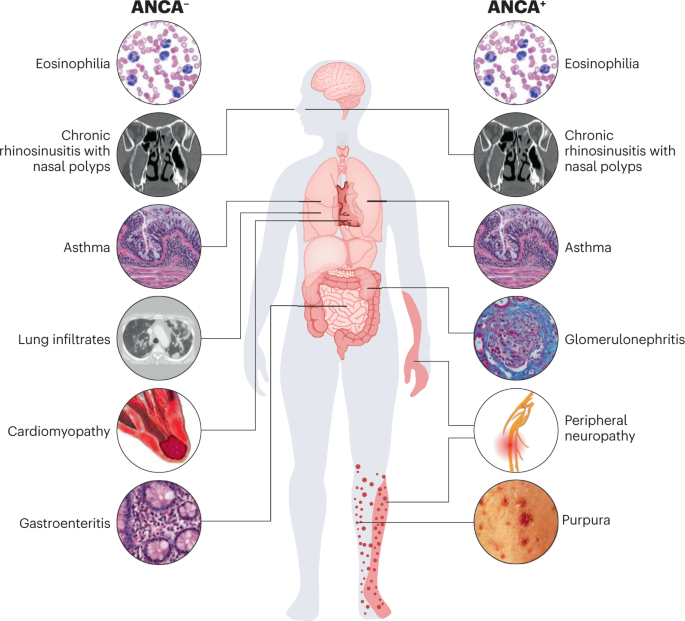 NatRevRheumatol's tweet photo. New content online! Evidence-Based Guideline for the diagnosis and management of eosinophilic granulomatosis with polyangiitis https://t.co/iBNSi55JfK https://t.co/Wh71oHGXOL