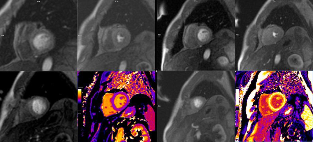 Hemos incorporado resonancia de estrés o perfusión, es una prueba de imagen avanzada de primera línea en  el estudio del dolor torácico en pacientes con sospecha o enfermedad de las arterias del corazon, donde es posible valorar la función, el riego y su viabilidad en una prueba