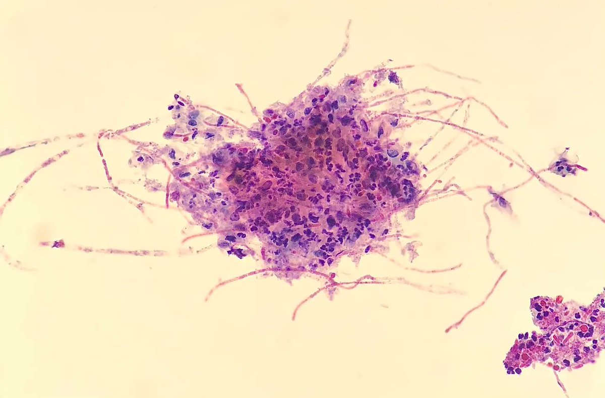 Gloria_SuraMD's tweet photo. Cervical Papanicolaou test revealing what organism? Answer: https://t.co/0A2dUIGRxn #IDTwitter #MedTwitter #PathTwitter #CytoPath #PathArt #Cytology https://t.co/5PRYt9CRxq