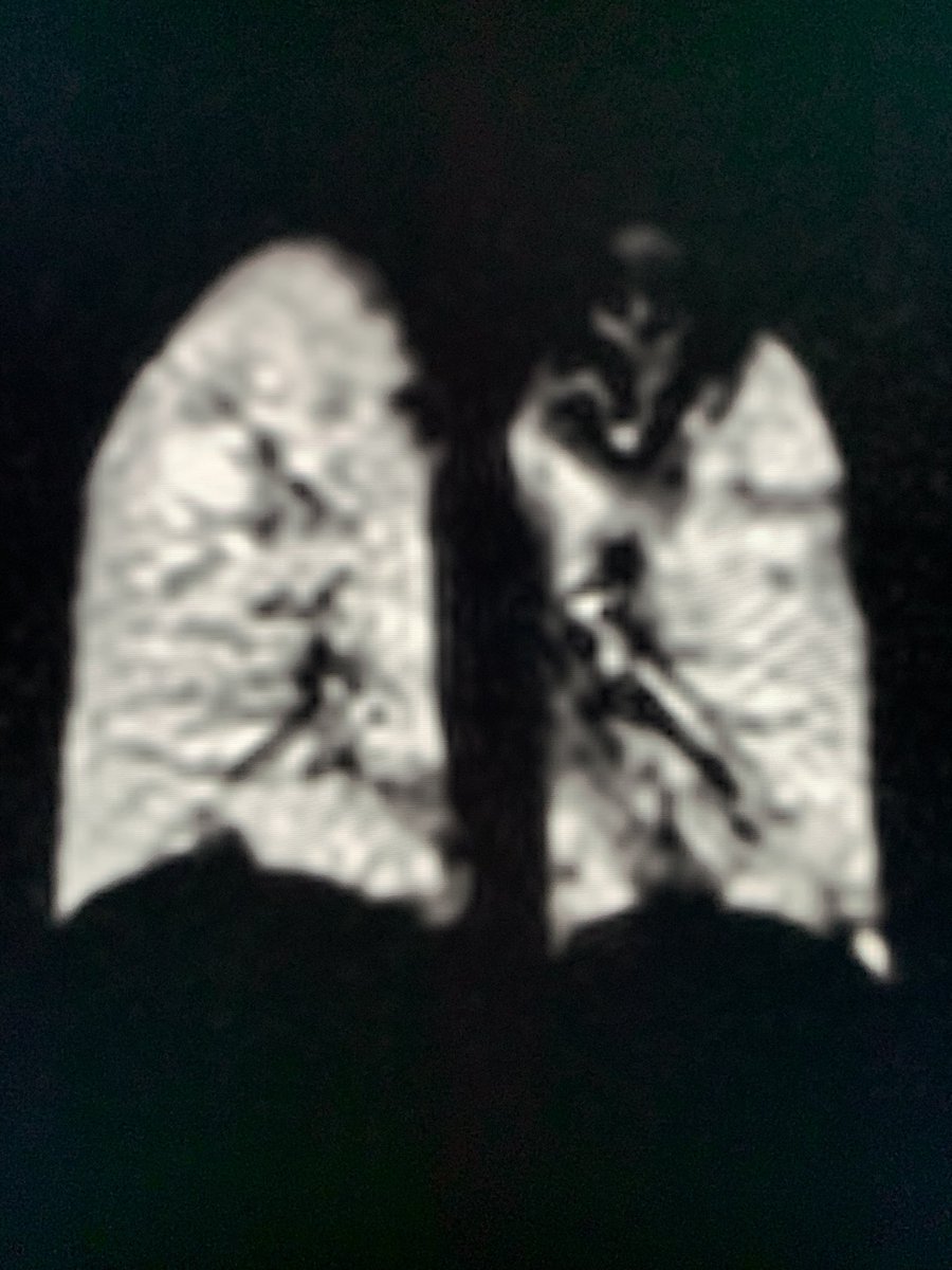 We did it!
Our #team <a href="/CincyKidsRad/">Cincy Kids Radiology</a> performed our 1st CLINICAL hyperpolarized #xenon #mri after FDA approval!
Proud to offer this new technique to our patients <a href="/CincyChildrens/">Cincinnati Children's</a> !
#pedsrad