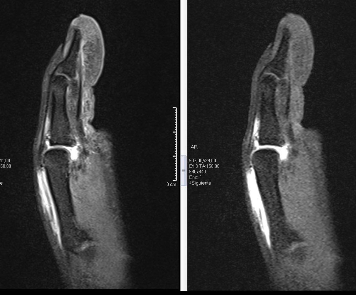 draulrikita's tweet photo. Nuevo caso. ArtroRM de dedo tras traumatismo. ¿Qué hallazgos veis?
¿Queréis que os hable de la técnica?@MskSerme @residentesSERAM https://t.co/WT7zMlUUil