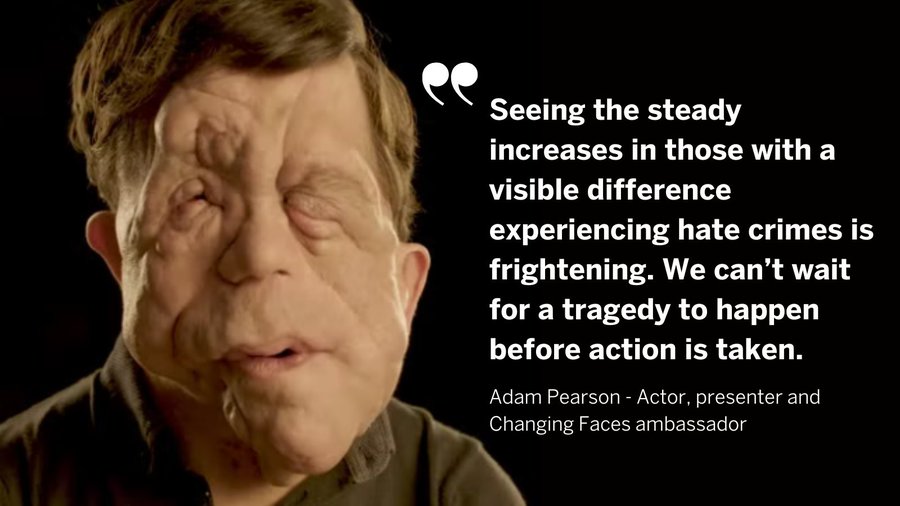 AACE_org's tweet photo. . @AACE_org, @NIAS999, @WelshAmbulance and the ten English #NHS #Ambulance Services join @Scotambservice Service in signing up to @FaceEquality's commitment to support people with #VisibleDifferences &amp; #disfigurements.

👉 https://t.co/cPkhPipiAa

#FaceEqualityWeek #StopTheStare https://t.co/YLN4AtgDuG