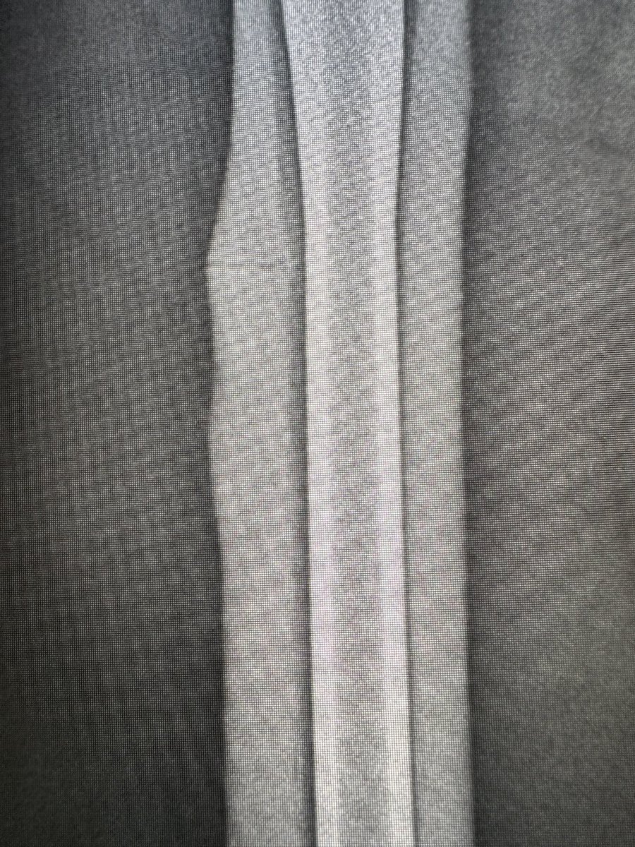 northwoods1980's tweet photo. Atypical/bisphosphonate/insufficiency…fracture not to be missed https://t.co/VU9adOWww7