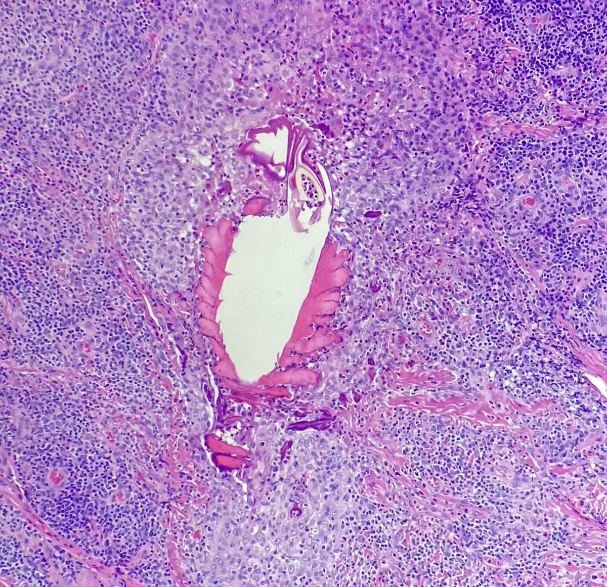 gasannaa's tweet photo. Uninvited guest in the dermis #dermatology #dermpath #pathology #dermatopathology #Skin #Derma https://t.co/Bt6zBzIwcU