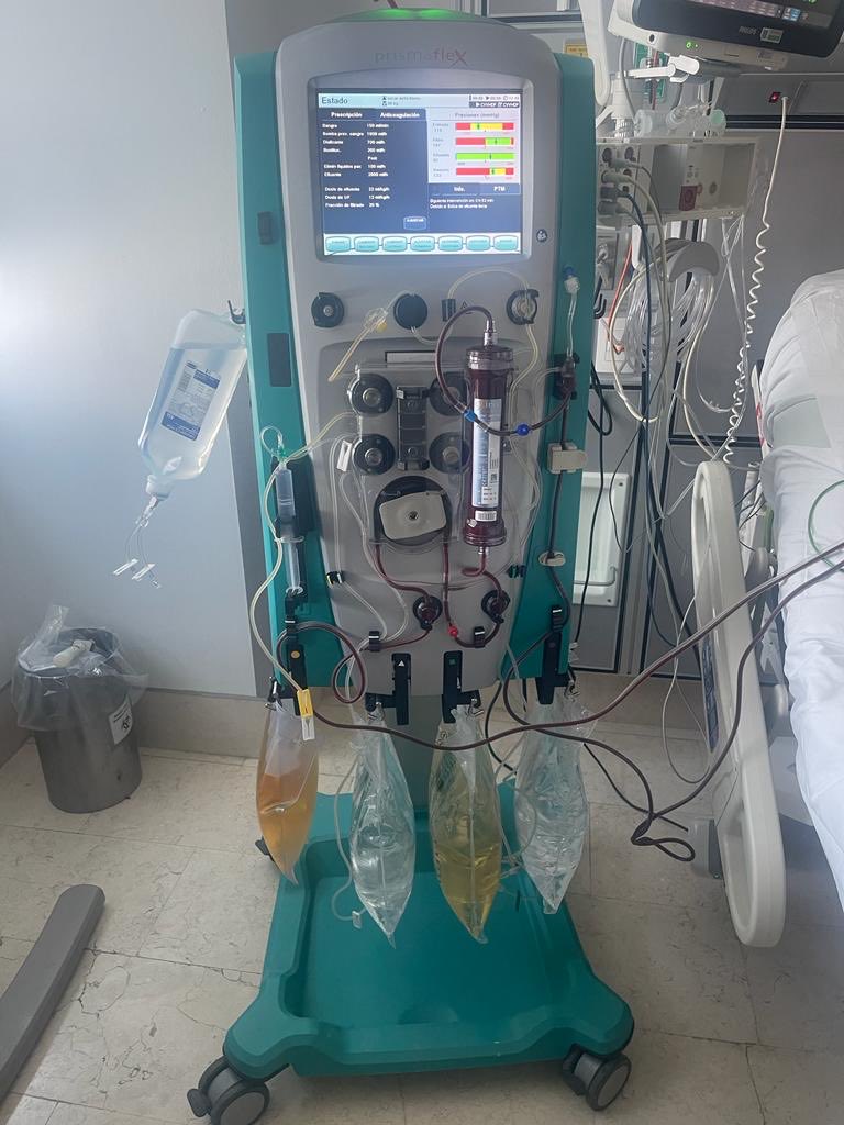 julius_md's tweet photo. Masc. 45 años, falla hepatica aguda + Lesión renal aguda, anurico, dependiente de norepinefrina y vasopresina, se opta por CRRT se aprovecha inicio de terapia agregando albumina a bolsa dializante [final 3%]
Single pass albumin dialysis #SPAD #CRRT #Prismaflex #AKI #ALF https://t.co/pLAK1hihl1