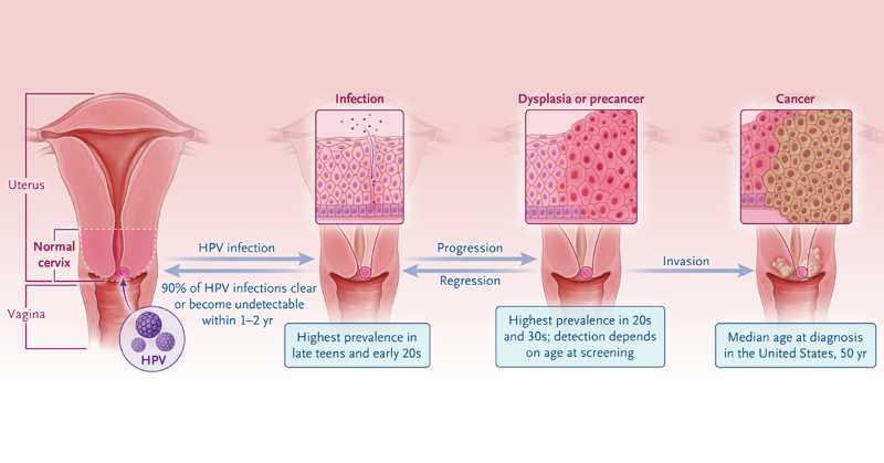 NEJM's tweet photo. HPV is a common sexually transmitted virus; oncogenic types lead to HPV-attributable cancers. Vaccines are highly effective for preventing HPV vaccine–type infection, precancers, and other attributable conditions. https://t.co/nF7l5zwCKt
