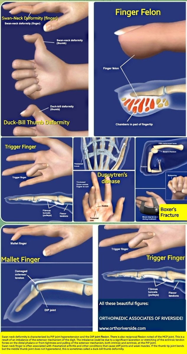 OBandarchi's tweet photo. 🛑Some common conditions in the hand and specifically fingers,beautifully shown👍👏👏👏 https://t.co/4MuctYgbzi