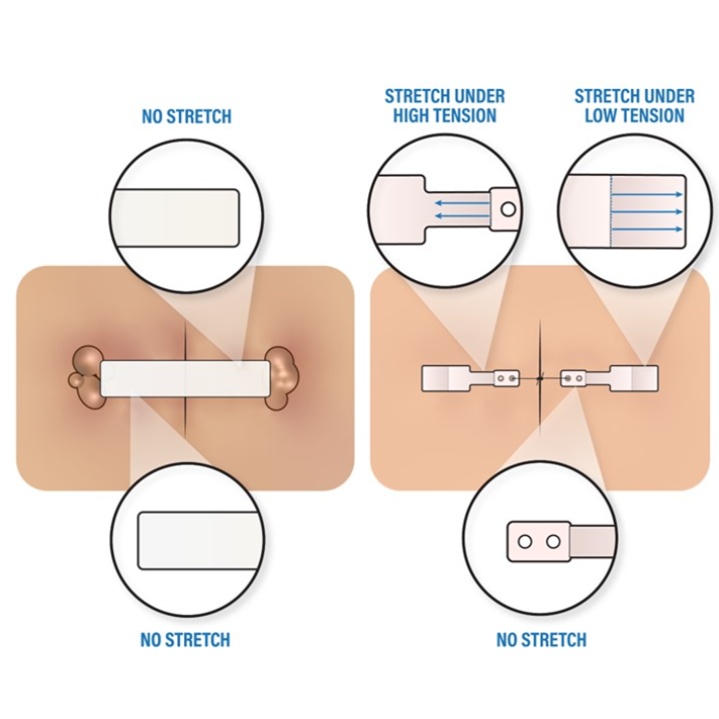 Differential stiffness HEMIGARD ASRD - no stretch near wound; stretch under high tension next; ends stretch under low tension to avoid blistering. HEMIGARD devices have been shown to improve outcomes and reduce complications. #mohs #hemigard #retentionsuture #acms #noundermining