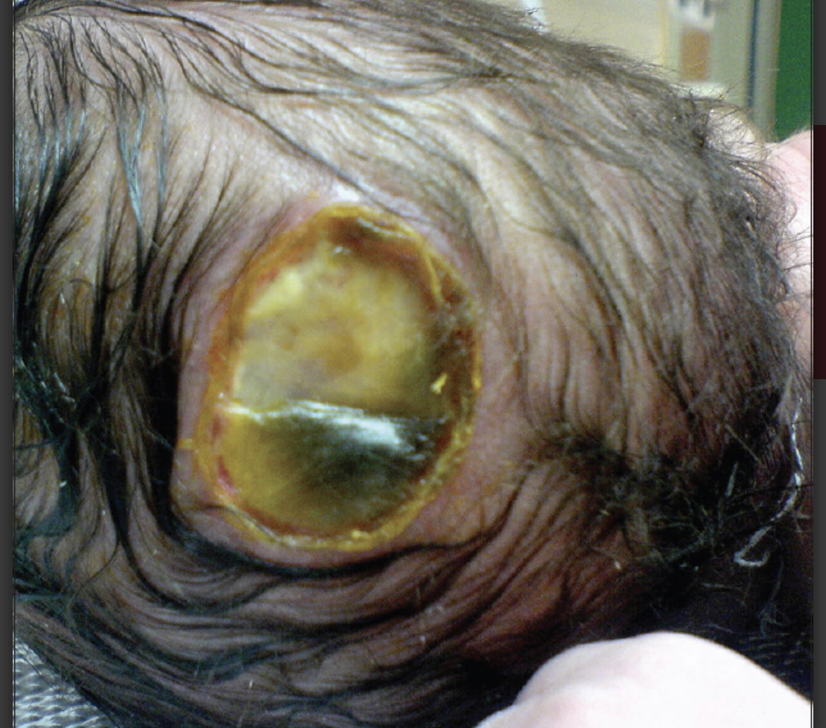 OGdukeneurosurg's tweet photo. Healthy newborn with these two scalp lesions? What do you see or don’t see? Treatment options? (Reference to follow, consent given) https://t.co/ZQapPh357Z