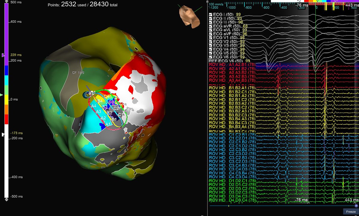 asanchezEP's tweet photo. Beautiful Ischemic VT ablation mapped and ablated by @drjalajgarg utilizing #HDGrid. One-burn term achieved, utilizing 
1. #EnsiteX nearfield detection algorithm with #Emphasismaps 

2. #ILAM map achieved in VT with #lastdetection algorithm. 

#AbbottProud #OT @AbbottCardio https://t.co/MnygSCYtws