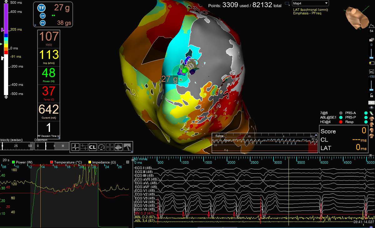 Beautiful Ischemic VT ablation mapped and ablated by <a href="/drjalajgarg/">Jalaj Garg</a> utilizing #HDGrid. One-burn term achieved, utilizing 
1. #EnsiteX nearfield detection algorithm with #Emphasismaps 

2. #ILAM map achieved in VT with #lastdetection algorithm. 

#AbbottProud #OT <a href="/AbbottCardio/">Abbott Cardiovascular</a>