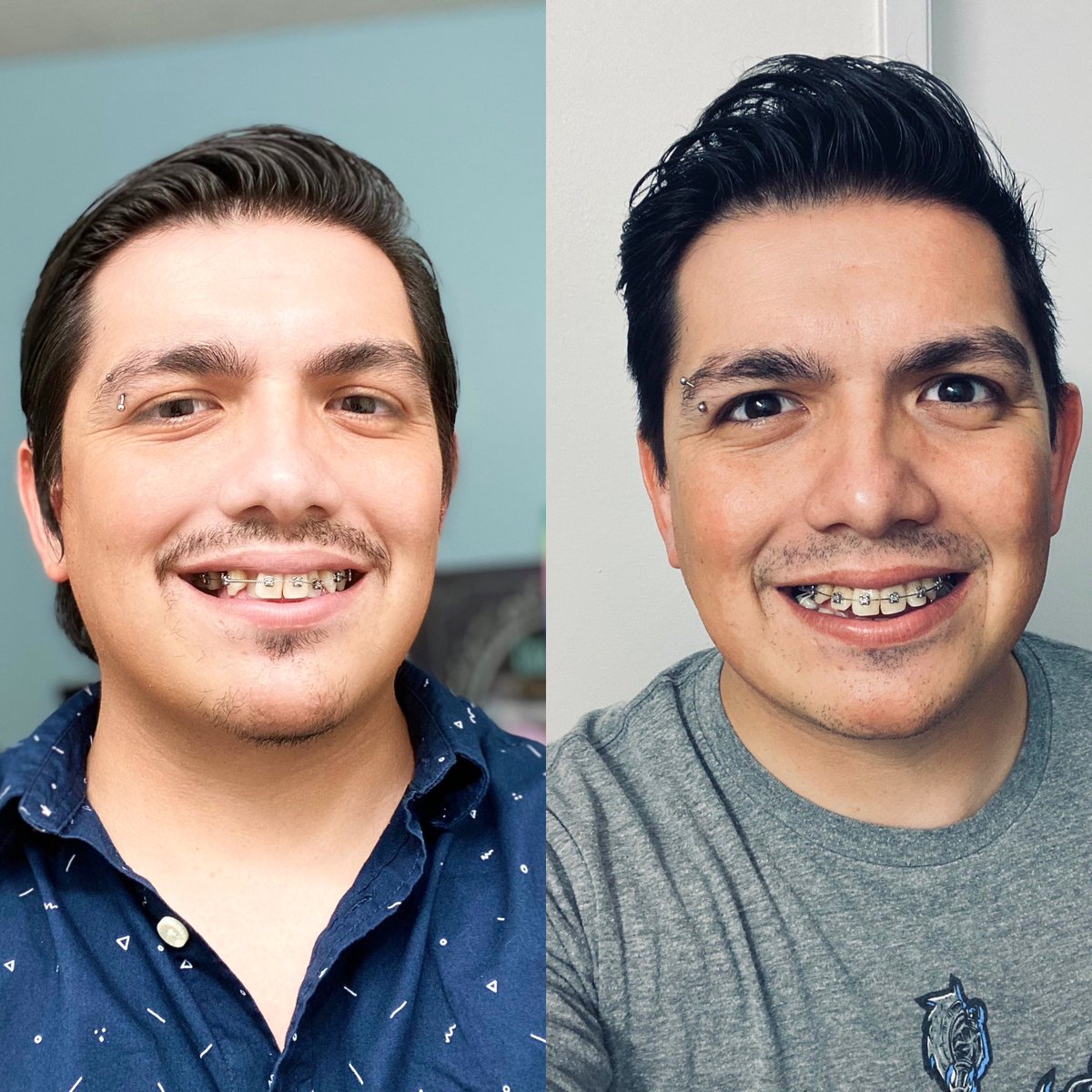 1 year done with braces, about a year left to go!

I’ve already seen a pretty big difference - no more teeth hiding behind other ones!

Now it’s about alignment with rubber bands strapped to my teeth. haha
