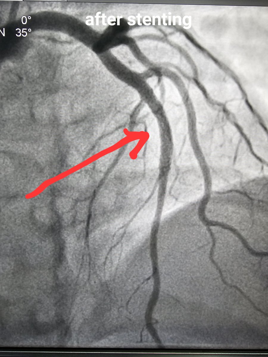 DrDeepakKrishn1's tweet photo. 26y old girl. Working in clinical research. Came with chest pain. ECG was abnormal. Advised to get admitted and undergo angio. Only friends had accompanied. Reluctant. Family had to come from Chennai. Finally got admitted after 3 hours of deliberation. 
I insisted on admission and went and spoke to them in ER bcos she is a diabetic since 10 years and symptoms were typical. 
First Troponin negative. Second Troponin 16,400! (Cut off 11.0) 
Stabilized with medication and angio done today after family arrived. Showed LAD 90% blocked. Stented. Life saved. 
#MedTwitter #CardioTwitter #HeartAttack