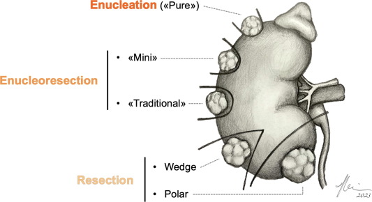 Resection Techniques During Robotic Partial Nephrectomy: A Systematic Review #Enucleation #Enucleoresection #partialnephrectomy #roboticsurgery @EurUrolOpen spkl.io/601445Gcn