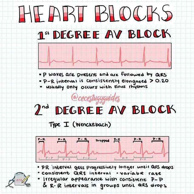 Medicine TA on Twitter "🫀HEART BLOCKS MedEd MedTwitter medicine 